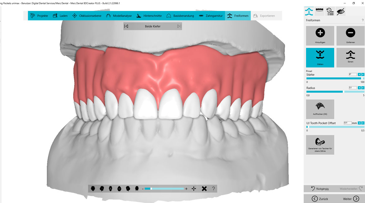 BDCreator PLUS: individuelle Frontzahnaufstellung
