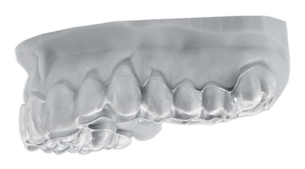 3D-gedruckte Aufbisschiene auf Modell aus M-PRINT Splint