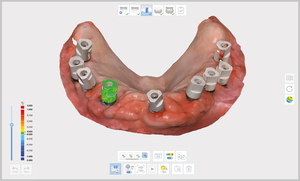 Abutments und Scanbodies werden automatisch an die Scandaten angepasst